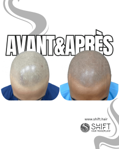 Avant Après de la micropigmentation du cuir chevelu pour un look rasé en Turquie chez SHIFT Hair à Istanbul 67 3