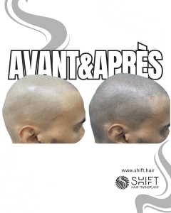 Avant Après de la micropigmentation du cuir chevelu pour un look rasé en Turquie chez SHIFT Hair à Istanbul 70 3