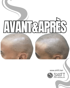 Avant Après de la micropigmentation du cuir chevelu pour un look rasé en Turquie chez SHIFT Hair à Istanbul 71 3