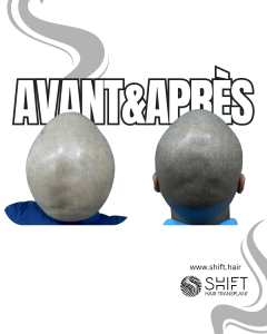 Avant Après de la micropigmentation du cuir chevelu pour un look rasé en Turquie chez SHIFT Hair à Istanbul 72 3