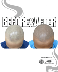 Scalp Micropigmentation for the Shaved Look Turkey Before After SHIFT Hair Transplant in Istanbul 67 3