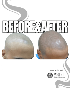 Scalp Micropigmentation for the Shaved Look Turkey Before After SHIFT Hair Transplant in Istanbul 68 3