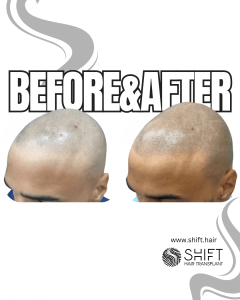 Scalp Micropigmentation for the Shaved Look Turkey Before After SHIFT Hair Transplant in Istanbul 69 3