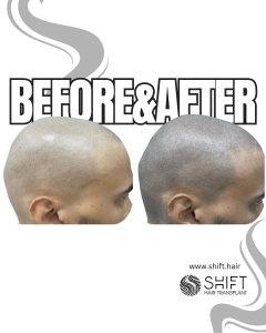 Scalp Micropigmentation for the Shaved Look Turkey Before After SHIFT Hair Transplant in Istanbul 70 3