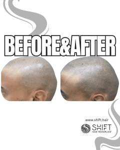 Scalp Micropigmentation for the Shaved Look Turkey Before After SHIFT Hair Transplant in Istanbul 71 3