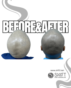 Scalp Micropigmentation for the Shaved Look Turkey Before After SHIFT Hair Transplant in Istanbul 72 3