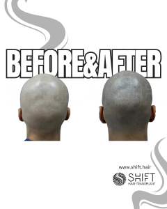 Scalp Micropigmentation for the Shaved Look Turkey Before After SHIFT Hair Transplant in Istanbul 73 3