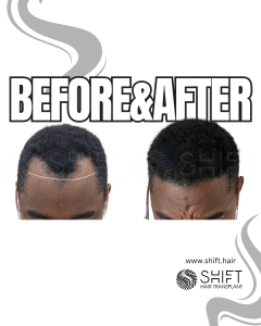Afro Hair Transplant Turkey Before After SHIFT Hair Transplant in Istanbul 46 3