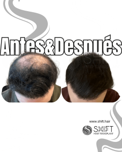 Antes Después de un trasplante capilar de corona en Turquía en SHIFT Hair en Estambul 07 3