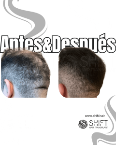 Antes Después de un trasplante capilar de corona en Turquía en SHIFT Hair en Estambul 08 3
