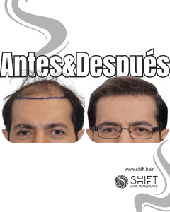 Antes y después de un trasplante capilar para la calvicie de Norwood 4 en Turquía en SHIFT Hair en Estambul 28 3
