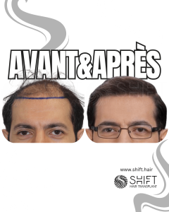 Avant Après de Greffe de Cheveux pour Calvitie Norwood 4 en Turquie chez SHIFT Hair à Istanbul 28 3
