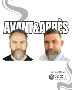 Avant Après de Greffe de Cheveux pour Calvitie Norwood 4 en Turquie chez SHIFT Hair à Istanbul 29 3