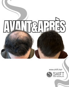 Avant Après la greffe de cheveux Crown en Turquie chez SHIFT Hair à Istanbul 07 3