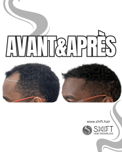 Avant Après une greffe de cheveux afro en Turquie chez SHIFT Hair à Istanbul 47 3