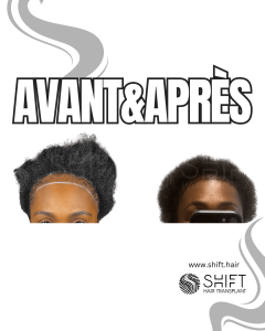 Avant Après une greffe de cheveux pour femmes en Turquie chez SHIFT Hair à Istanbul 16 3