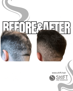 Crown Hair Transplant Turkey Before After SHIFT Hair Transplant in Istanbul 08 3