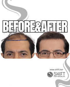 Hair Transplant Turkey Before After Norwood 4 Baldness SHIFT Hair Transplant in Istanbul 28 3