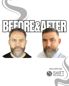 Hair Transplant Turkey Before After Norwood 4 Baldness SHIFT Hair Transplant in Istanbul 29 3