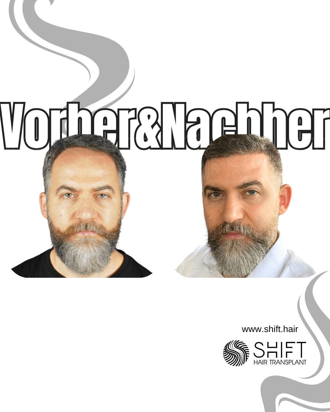 SHIFT Haartransplantation Türkei Ergebnisse 49