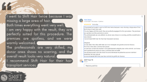Hair Transplant Review with SHIFT Hair in Turkey 30 3