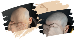 Homepage Image of Scalp Micropigmentation in Istanbul Turkey 3