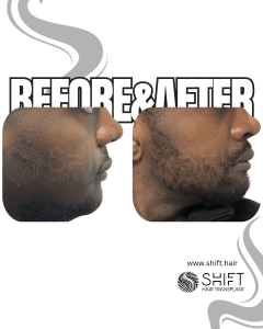 Afro Beard Transplant Turkey Before After SHIFT Hair Transplant in Istanbul 09 3