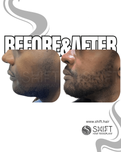 Afro Beard Transplant Turkey Before After SHIFT Hair Transplant in Istanbul 10 3