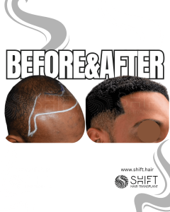 Afro Hair Transplant Turkey Before After SHIFT Hair Transplant in Istanbul 48 3