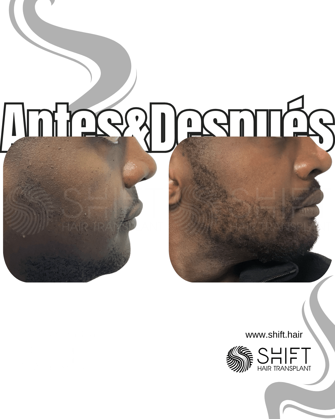 SHIFT Trasplante Capilar Turquía Resultados 305