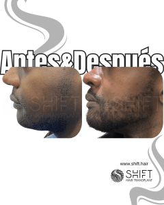 Antes Después de un trasplante de barba afro en Turquía en SHIFT Hair en Estambul 10 3