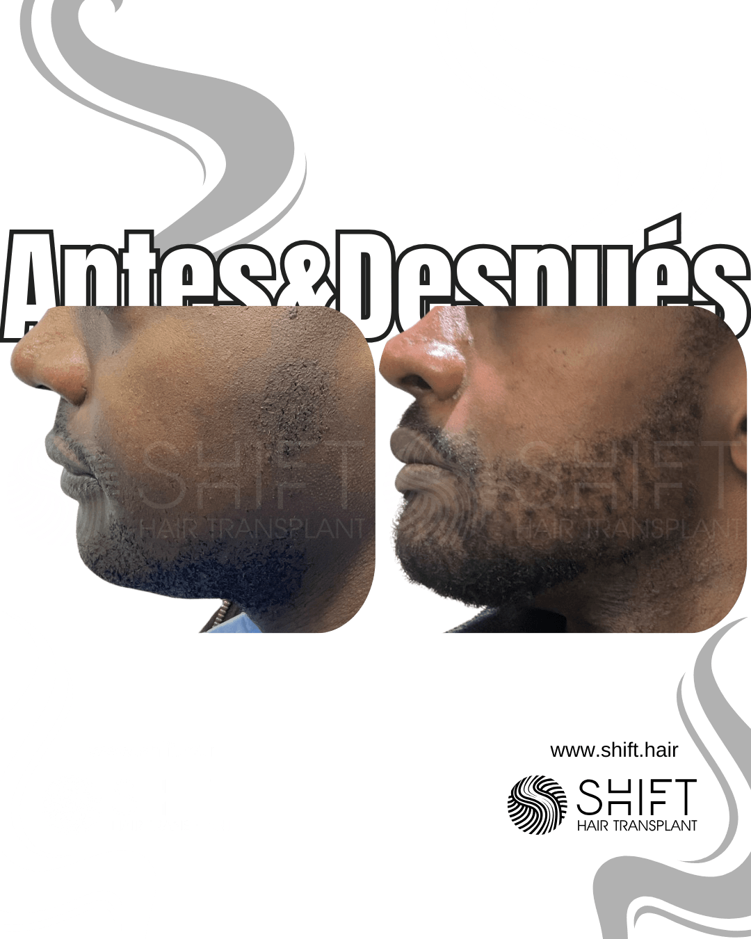 SHIFT Trasplante Capilar Turquía Resultados 306
