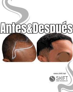 Antes Después de un trasplante de cabello afro en Turquía en SHIFT Hair en Estambul 48 3