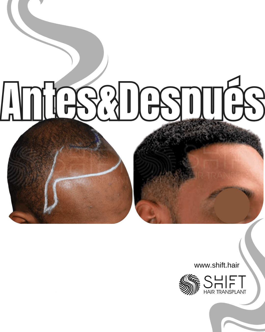 Trasplante de cabello Afro 53