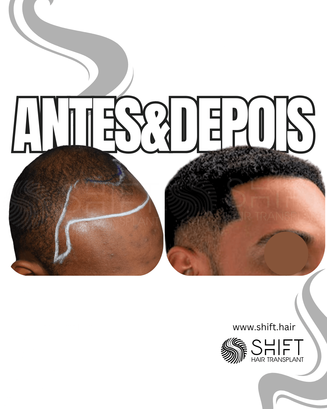 Transplante de cabelo Afro 53