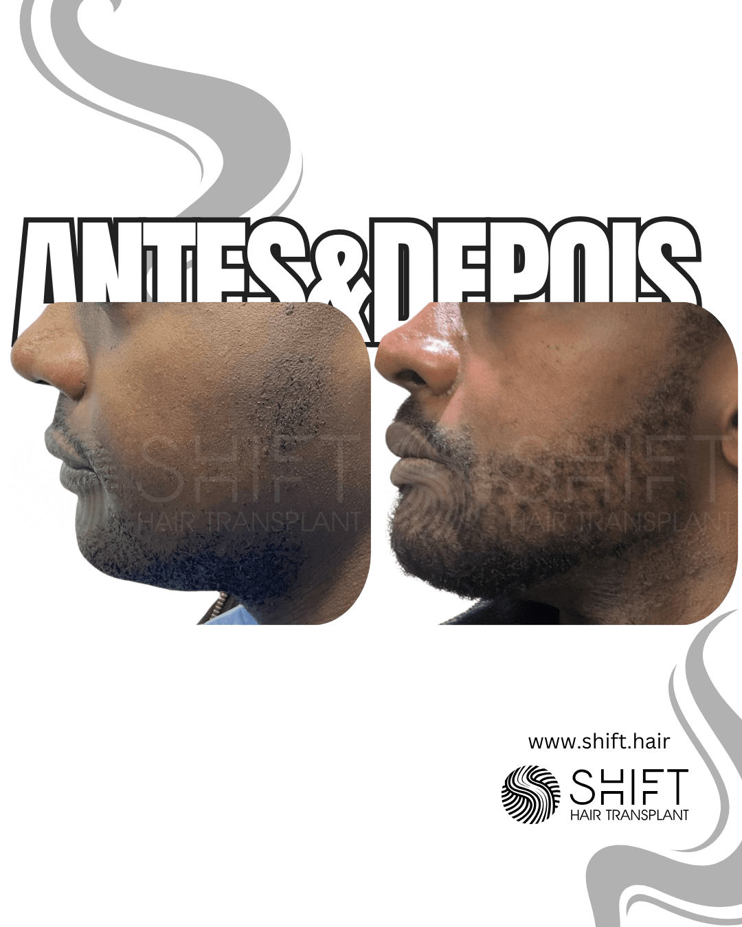 Transplante de Barba 41