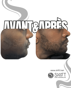Avant Après une greffe de barbe afro en Turquie chez SHIFT Hair à Istanbul 09 3