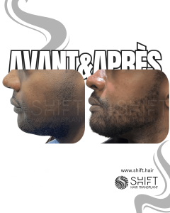 Avant Après une greffe de barbe afro en Turquie chez SHIFT Hair à Istanbul 10 3