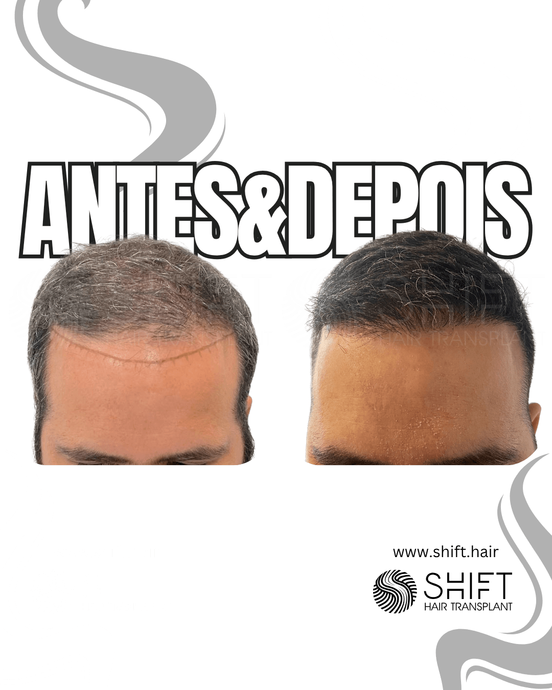 Transplante de cabelo na Turquia 56