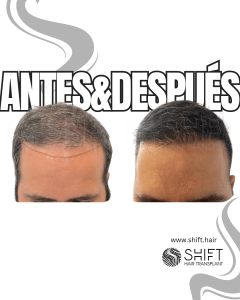 Antes y después de un trasplante capilar para la calvicie de Norwood 4 en Turquía en SHIFT Hair en Estambul 30 3