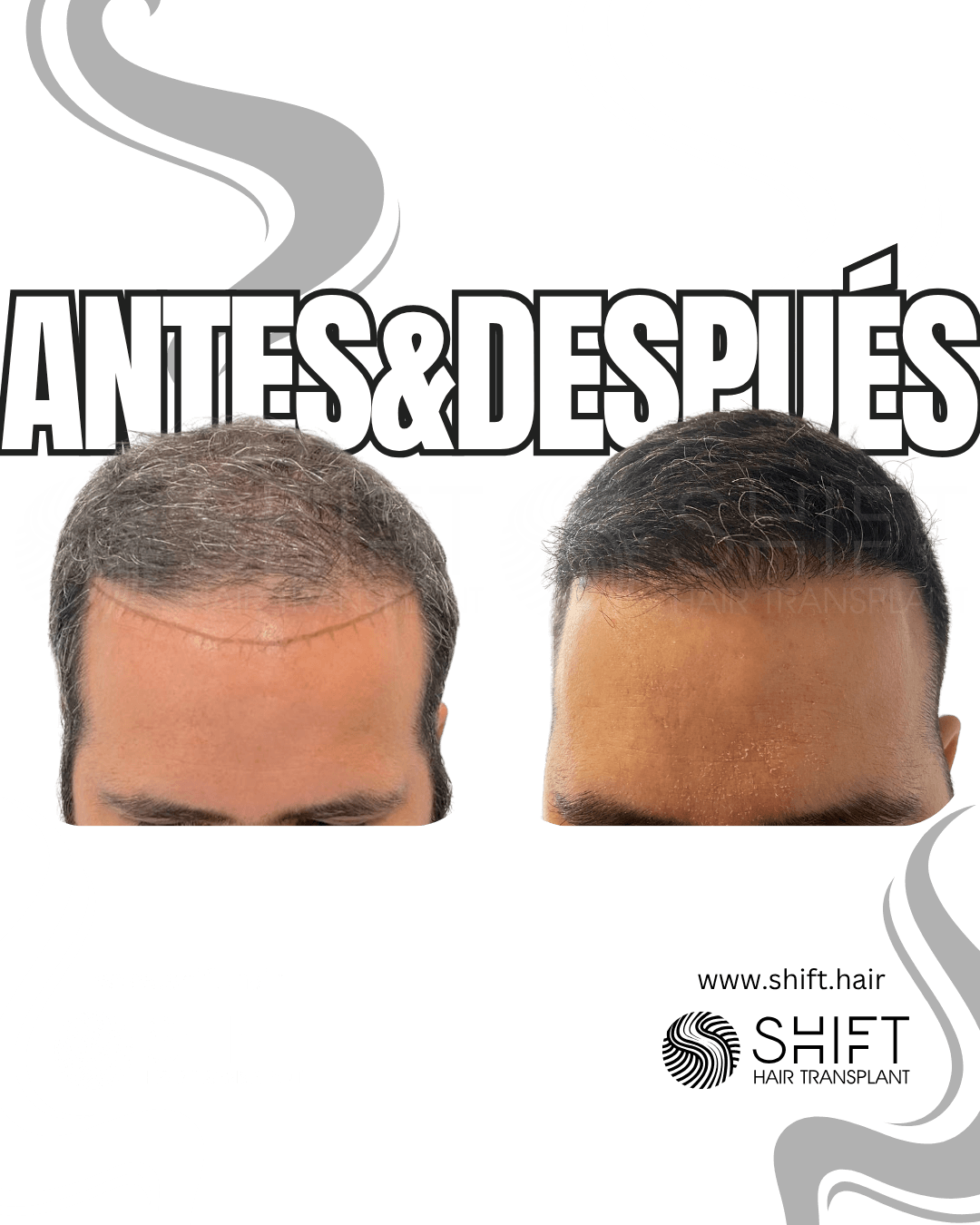 Trasplante capilar en Turquía 56