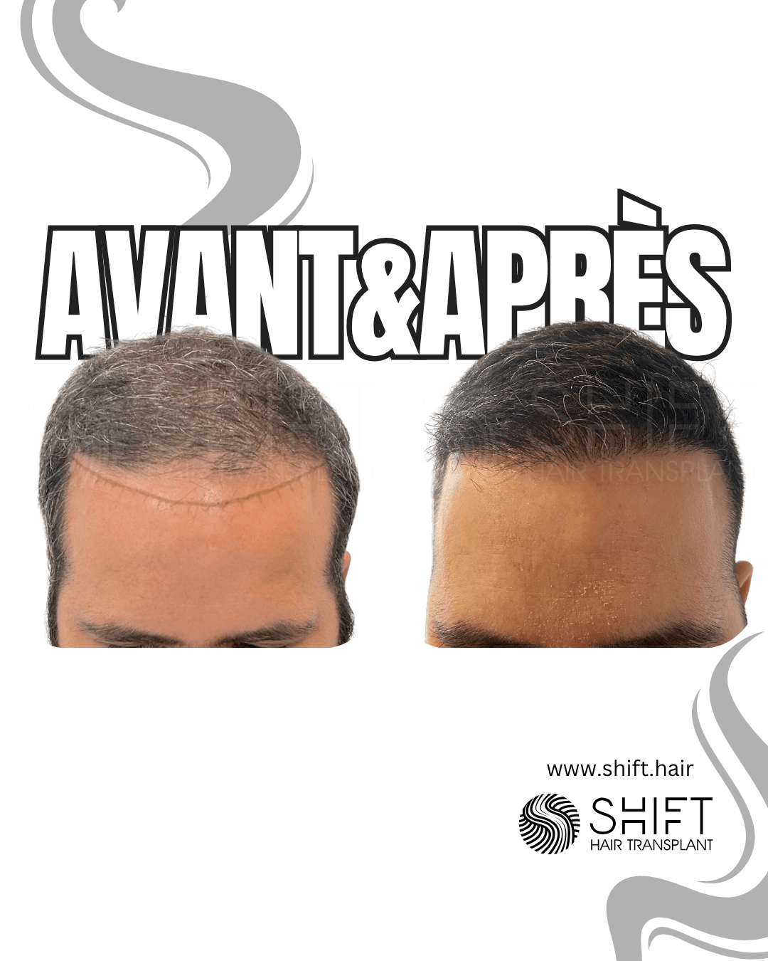 SHIFT Greffe de Cheveux Turquie Résultats 49