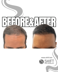 Hair Transplant Turkey Before After Norwood 4 Baldness SHIFT Hair Transplant in Istanbul 30 3