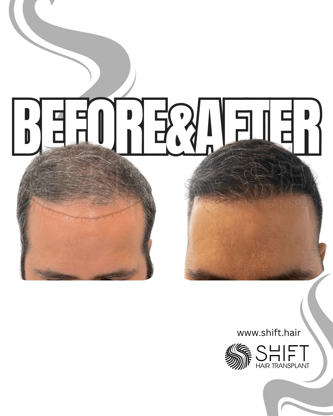 SHIFT Hair Transplant Turkey Results 49