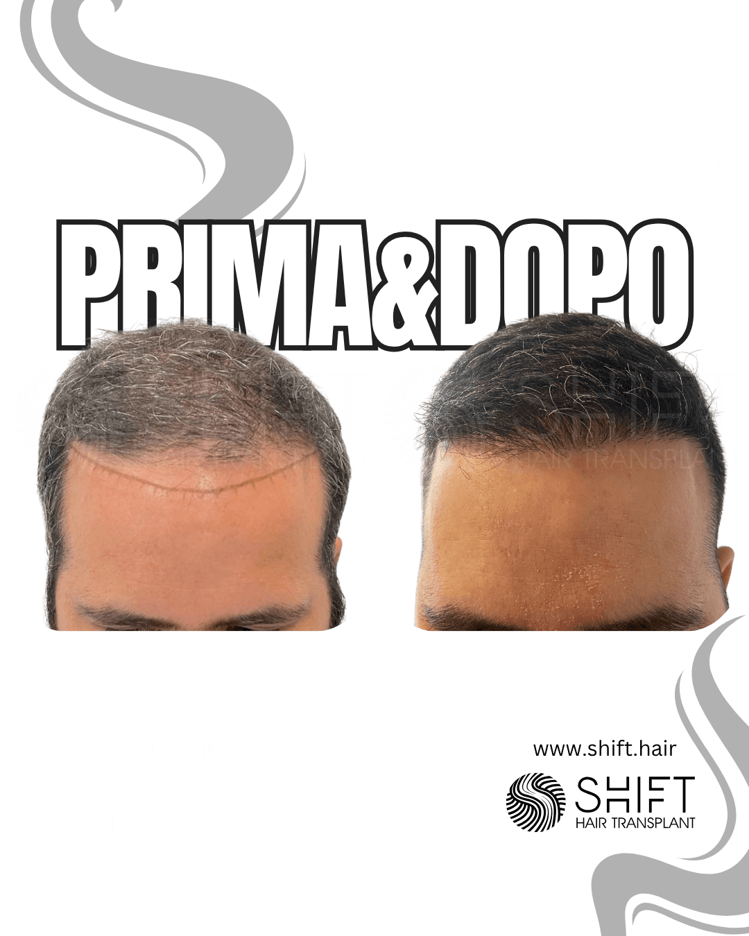 Trapianto di capelli in Turchia 56