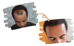 Afro Hair Transplant SHIFT Hair TR Main Image 3