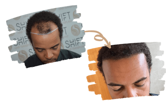 Trasplante de cabello Afro 1